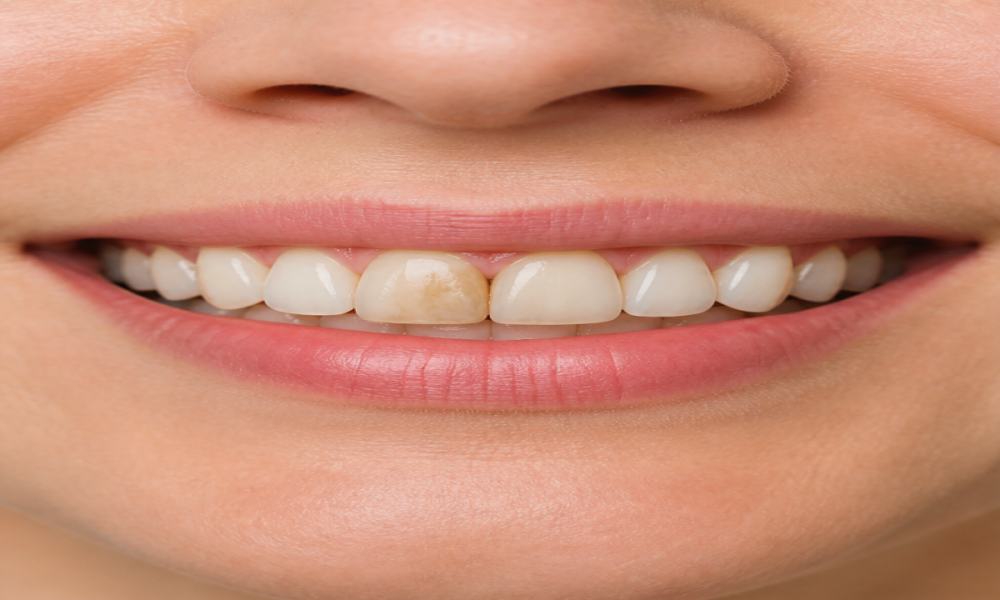 Avant - Sourire restauré